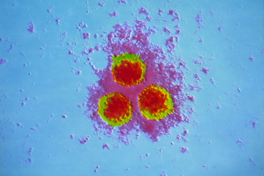Specialists Debunk COVID-19 Vaccine-Shingles Hyperlink