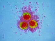 Specialists Debunk COVID-19 Vaccine-Shingles Hyperlink shingles